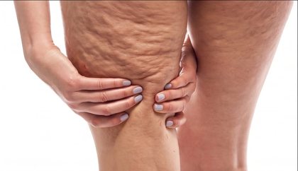 Grau 3 de celulite: ondulação visível em repouso
