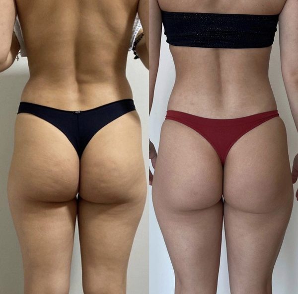 Antes e depois de uma aluna da Crew, glúteo e posterior